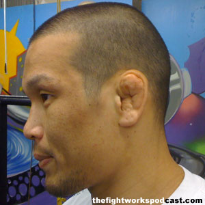 Lesion frecuente en Judo? - Página 2 Cauliflower-ear-baret