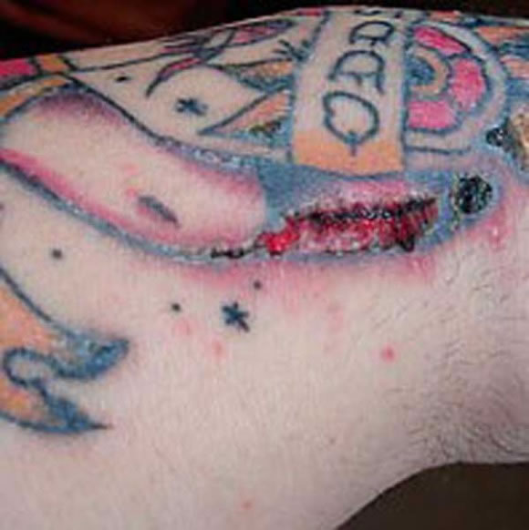 Infecciones de tatuajes y perforaciones Tatuajes_y_perforaciones_21