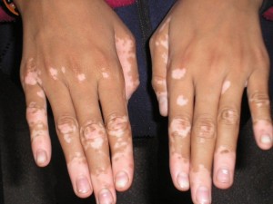 15 NİSAN 2018 PAZAR BULMACASI SAYI : 1672 - Sayfa 2 Vitiligo-hastalaaa-nedir-tedavisi-mmkn-mdr