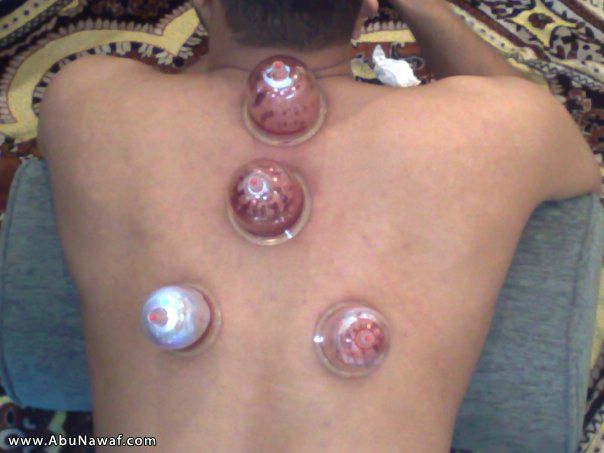 ماذا تعرف عن الحجامه CUPPING N1006664066_40134_2410