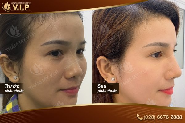  Khuyến mãi thẩm mỹ VIP: “MŨI xinh SIÊU – CHILL VỚI VIP” Khuyen-mai-tham-my-vip-3-e1559545359612