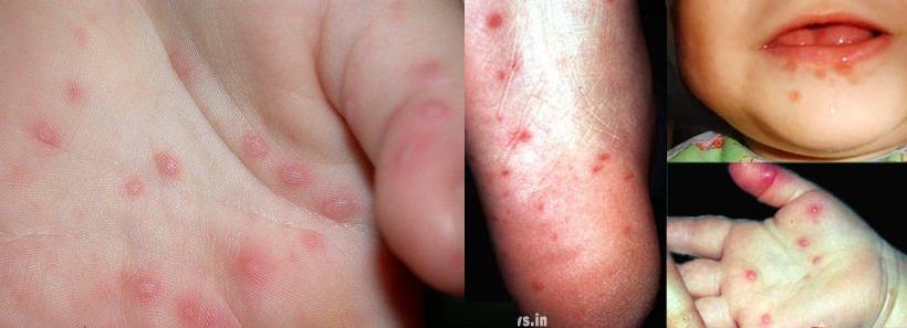 malattia mani-piedi-bocca Hand_foot_and_mouth_disease