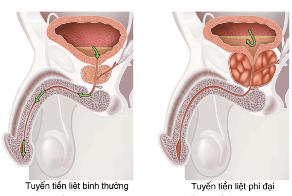 Yếu tố gây ra bệnh phì đại tiền liệt tuyến và kỹ thuật chữa Cach-chua-benh-phi-dai-tuyen-tien-liet