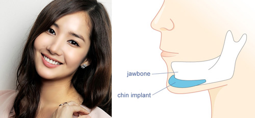 Nhiều bạn gái rất quan tâm về việc độn cằm ở đâu đẹp Don-cam-o-dau-dep-6