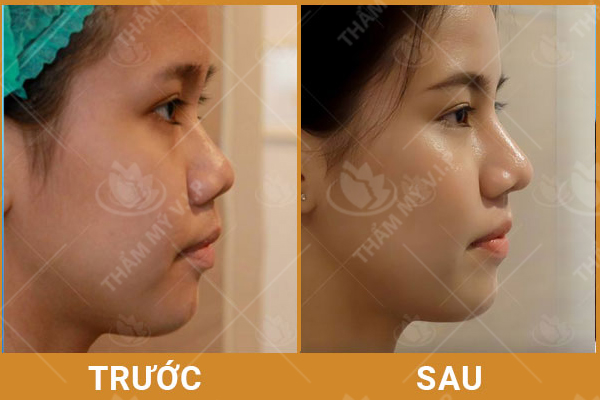 Nâng mũi Filler có an toàn không? - Bảng giá tiêm filler Nang-mui-co-anh-huong-gi-khong-khach1