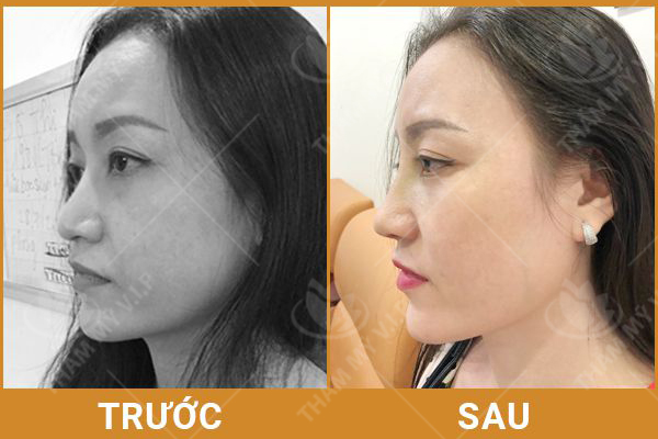 Nâng mũi Filler có an toàn không? - Bảng giá tiêm filler Nang-mui-co-anh-huong-gi-khong-khach2