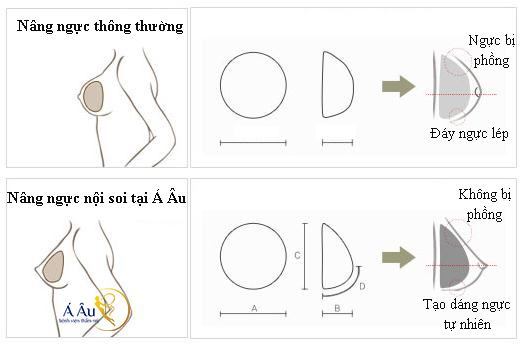 Nâng ngực nội soi là gì? Nang-nguc-noi-soi-bang-tui-4