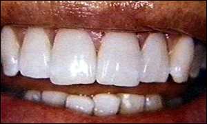 الأسنان المريضة تتلف الرئتين !!!! _1143820_whitenedteeth300