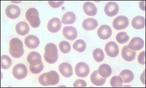 نقص الحديد يُضعف الذكاء _864446_red_blood_cells300