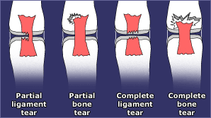 Healing ligament damage _40842176_ligament