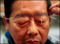 الإبر الصينية "توقف الإحساس بالألم" _41088501_acupunctureap203