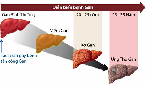 Bệnh Men Gan Tăng Cao Và Một Số Điều Cần Nắm Rõ  Dien-bien-cac-benh-ve-gam