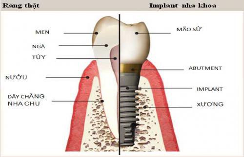 Có thế làm cầu răng thay thế cho implant được không ? Bao-duong-implant-nha-khoa-3