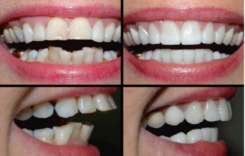 Bọc răng sứ cho răng cửa Boc-rang-su-cho-rang-cua-31