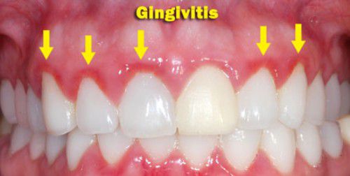 Bệnh nha chu và cách điều trị Cac-loai-benh-nha-chu-pho-bien-nhat-1