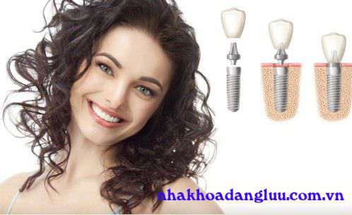 Sau khi cấy ghép implant có cần uống thuốc không ? Cac-phuong-phap-trong-rang-gia-hien-nay-1