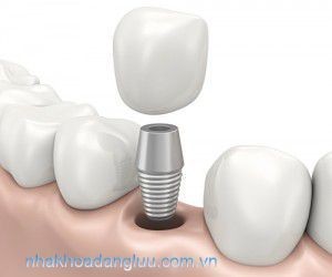 Chia sẻ những ưu điểm khi trồng răng implant Cac-phuong-phap-trong-rang-gia-hien-nay-4-300x2501-300x250