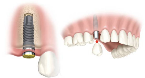 Cấy ghép implant có ưu điểm và hạn chế gì? Cham-soc-implant-the-nao-cho-hieu-qua