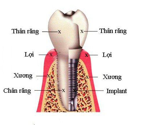 Trồng răng implant cho phụ nữ mang thai được không? Chi-dinh-va-chong-chi-dinh-cua-implant-1