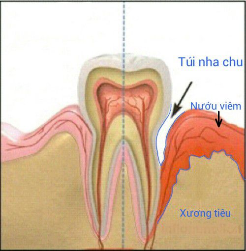 Chảy máu chân răng – không nên xem thường Nguyen-nhan-va-dac-diem-benh-viem-nha-chu