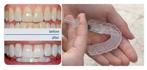 Kỹ thuật tẩy trắng răng an toàn, hiệu quả Nhung-cach-lam-trang-rang-tai-nha-khoa-hien-nay-4
