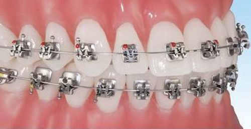 Các công nghệ niềng răng không thể bỏ qua Nieng-rang-mac-kim-loai-4