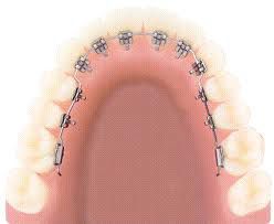 Niềng răng thẩm mỹ: mặt trong và trong suốt Nieng-rang-mat-trong-2
