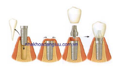 Sau khi cấy ghép răng implant nên ăn những gì Sau-khi-cay-ghep-rang-implant-nen-an-nhung-gi-1