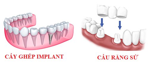 Tổng hợp cho bạn các phương pháp trồng răng giả Su-khac-biet-giua-trong-rang-su-va-cay-ghep-rang-implant-51