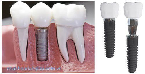 Tổng hợp cho bạn các phương pháp trồng răng giả Thoi-diem-cay-ghep-implant-thich-hop