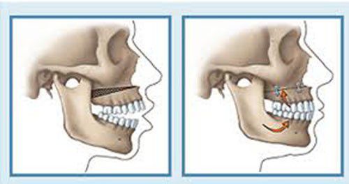 Hai giải pháp niềng răng hô và phẫu thuật hô Xuong-ham-the-nao-moi-dat-tieu-chuan-cay-ghep-implant