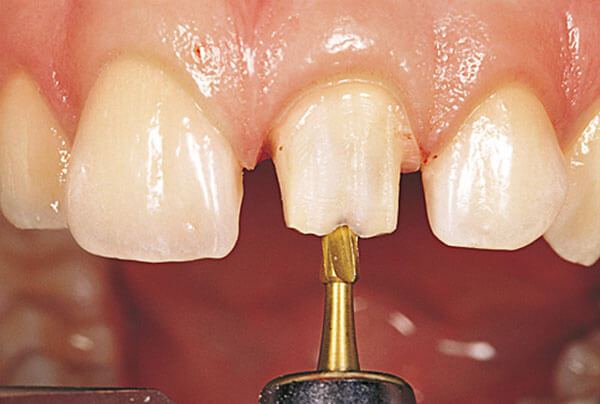 Bọc răng sứ xong bị ê buốt Nguyên nhân tại sao bởi đâu và khắc phục như nào Boc-rang-su-bi-e-buot-3-min