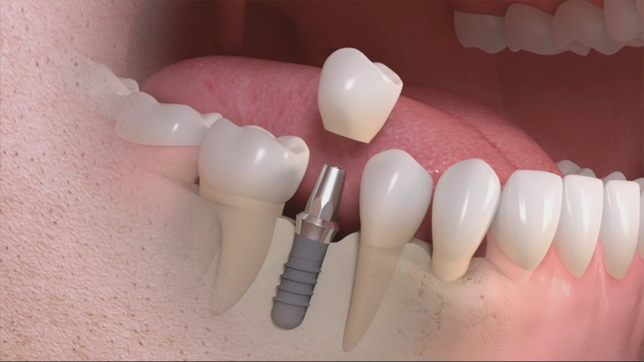 Bật mí những trường hợp nên trồng răng implant Trong-rang-implant2