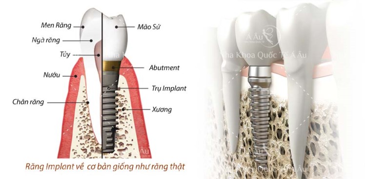 Hậu quả nghiêm trọng khi bị mất răng - Đừng chủ quan Hinh-minh-hoa-implant-nha-khoa-quoc-te-a-au