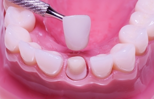 Tìm hiểu phương pháp bọc mão răng sứ cố định Dental-Crown1