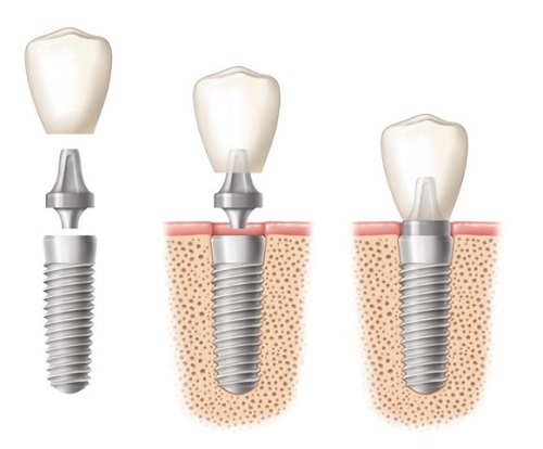 Thời điểm thích hợp để thực hiện cắm ghép implant sau khi nhổ răng Quy-trinh-trong-rang-implant