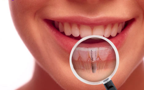 Quy trình trồng răng implant an toàn và chi phí của nó Trong-rang-implant-xua-va-nay-2