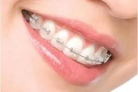 Niềng răng mất bao nhiêu thời gian? Nhung-dieu-can-biet-ve-chinh-nha-invisalign-2