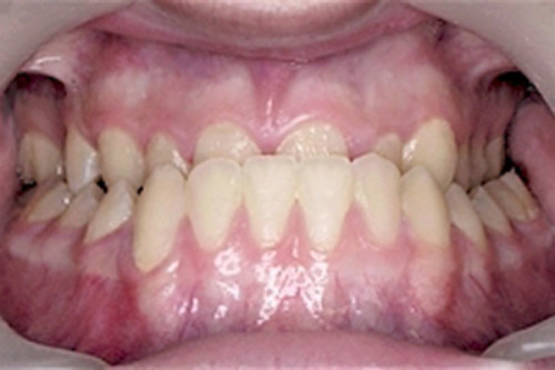 Thời điểm chỉnh răng hô thế nào là tốt nhất Nhung-truong-hop-nen-nieng-rang-2