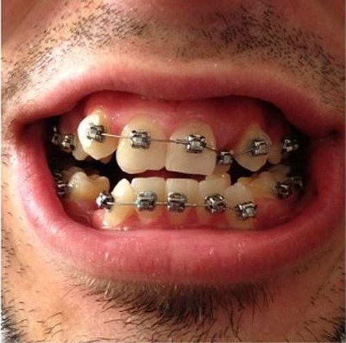 Niềng răng mất bao nhiêu thời gian? Braces_02