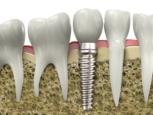 Quy trình trồng răng implant an toàn và chi phí của nó Lua-chon-tru-rang-Implant-2