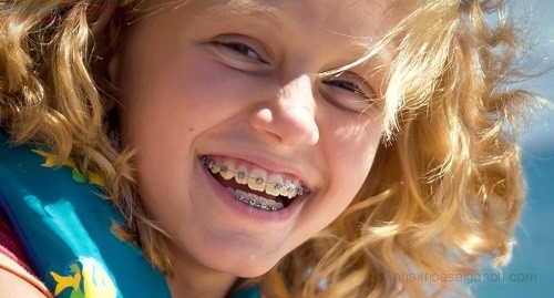 Chỉnh nha niềng răng khập khểnh mất bao lâu Ni%E1%BB%81ng-r%C4%83ng-h%C3%B4
