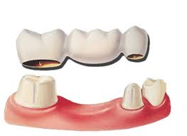 Phục hình bằng cầu răng sứ có đặc điểm gì ? Phuc-hinh-bang-cau-rang-su-co-dac-diem-gi-1