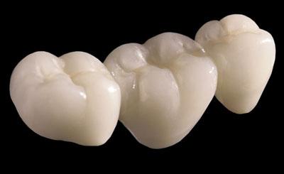Phục hình bằng cầu răng sứ có đặc điểm gì ? Phuc-hinh-bang-cau-rang-su-co-dac-diem-gi