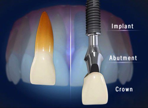 Chi phí cấy ghép răng implant Cay-ghep-implant-co-tot-khong-1-11