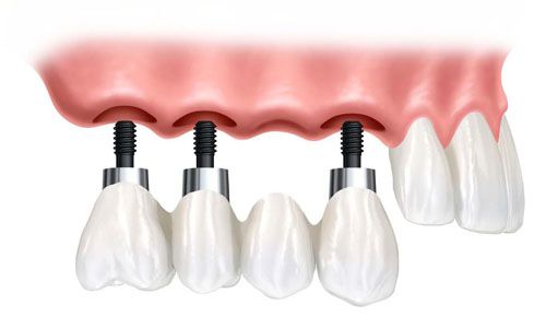 Chi phí cấy ghép răng implant Cay-ghep-implant-khi-bi-mat-mot-rang-cua-1