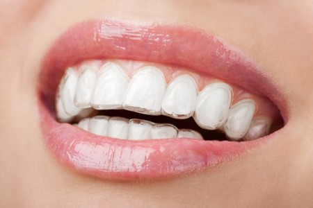 Những đặc điểm nổi bật của niềng răng invisalign Nhung-dac-diem-noi-bat-cua-nieng-rang-invisalign-01-450x300