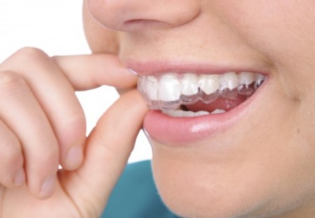 Những đặc điểm nổi bật của niềng răng invisalign Nhung-dac-diem-noi-bat-cua-nieng-rang-invisalign-450x311