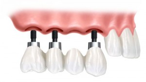 Trồng răng implant bị đau có lâu không? Trong-rang-implant-co-dau-lau-khong-300x170