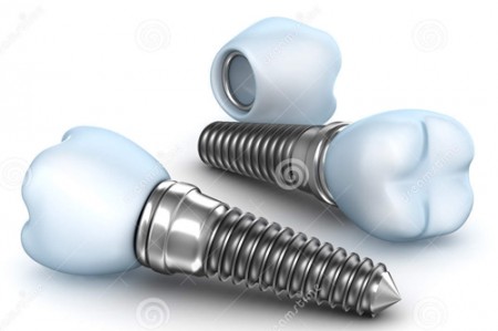 Ưu điểm của trụ răng implant Osstem Tai-sao-cay-ghep-tru-implant-co-chi-phi-cao-01-450x299